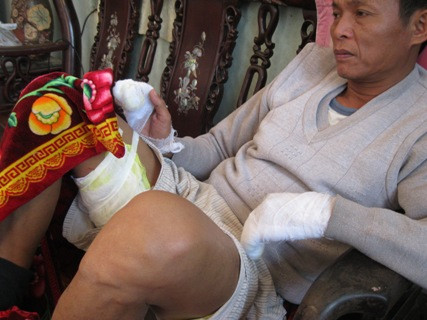 Ông Long bị bỏng trên đùi và tay Ông Long bị bỏng trên đùi và tay