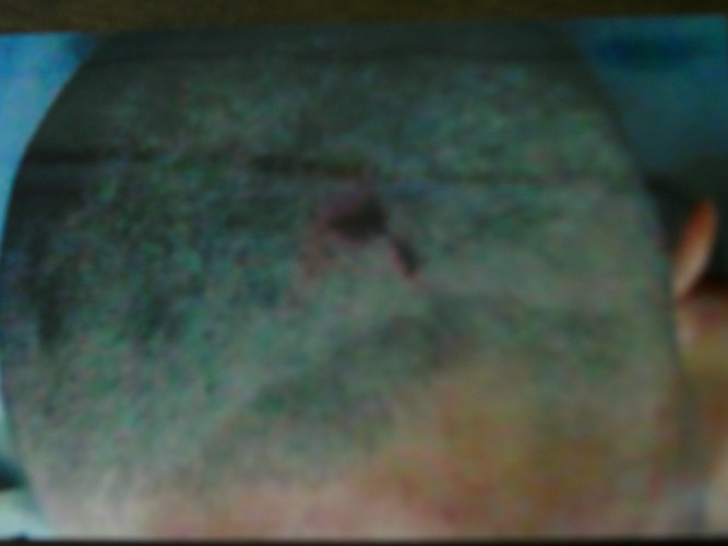 Vết bầm tím lạ trên đỉnh đầu anh Hiền. Vết bầm tím lạ trên đỉnh đầu anh Hiền.