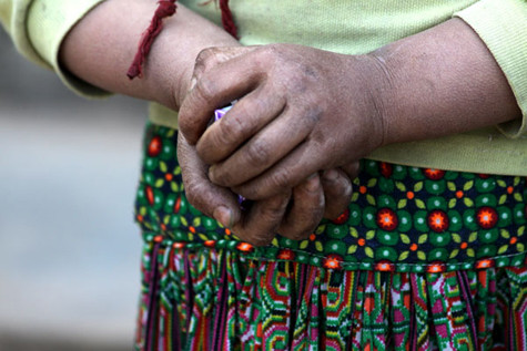 Những cánh tay phù nề vì lạnh của học sinh nghèo miền núi Những cánh tay phù nề vì lạnh của học sinh nghèo miền núi