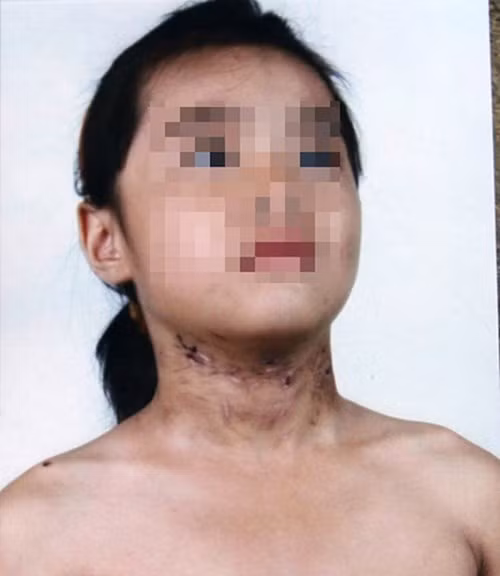 Cháu Nguyễn Minh Thu bị bố đẻ của mình đánh đập dã man