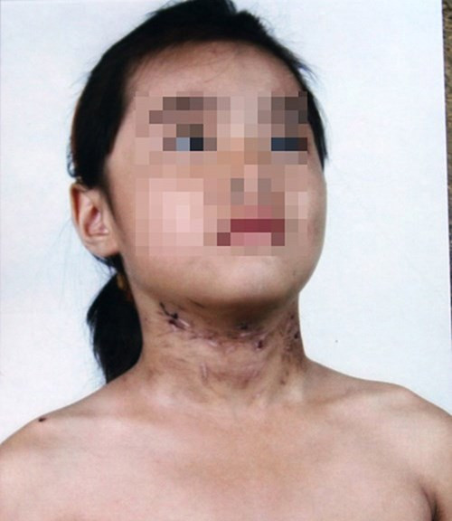 Cháu Nguyễn Minh Thu bị bố đẻ của mình đánh đập dã man