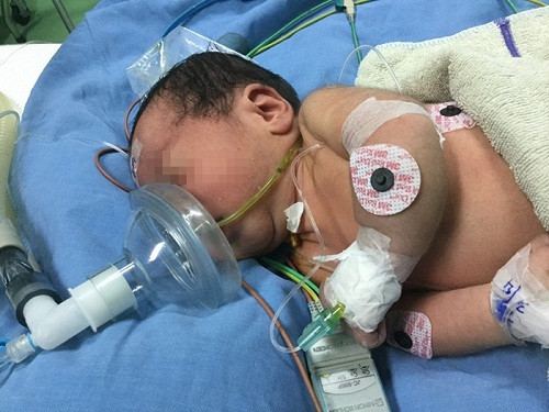 Bệnh nhi tự thở ngay sau phẫu thuật. Ảnh: BV Nhi Trung ương. Bệnh nhi tự thở ngay sau phẫu thuật. Ảnh: BV Nhi Trung ương.