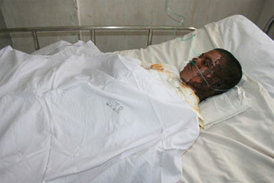 Bị bỏng 87% cơ thể, anh TỴ đang trong tình trạng "thập tử nhất sinh"