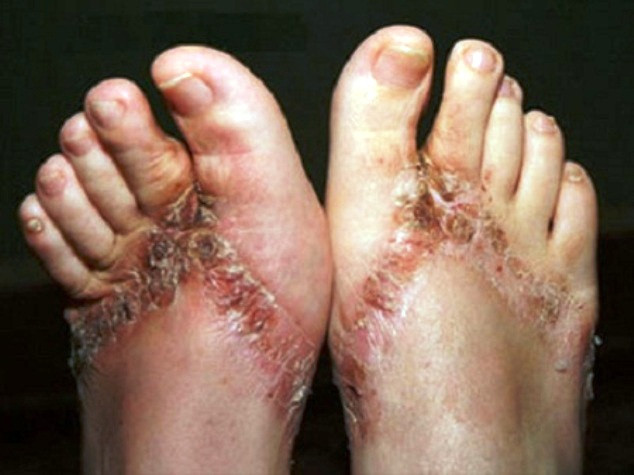 Hình ảnh được ghi tại blog của một "nạn nhân" từ dép Trung Quốc- Ảnh minh họa