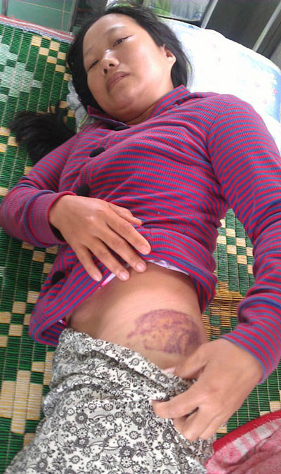 Dấu vết để lại sau trận đòn tàn nhẫn của chồng trên người chị Tưởng.