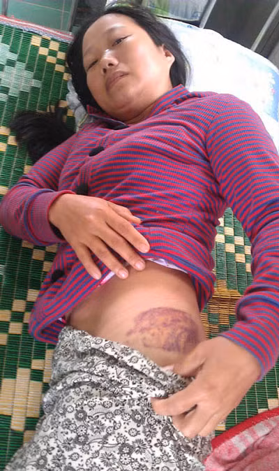 Dấu vết để lại sau trận đòn tàn nhẫn của chồng trên người chị Tưởng.