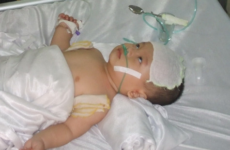 Bé Quỳnh bị cha ném vỡ sọ một năm trước.