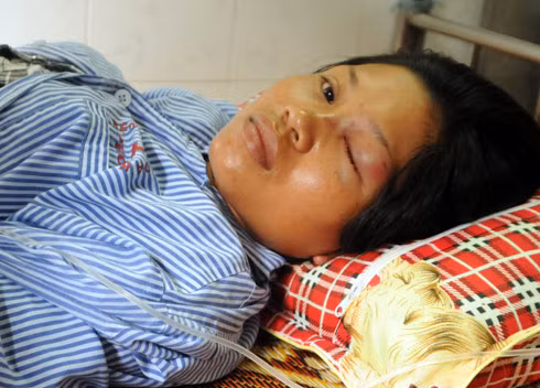 Chị Thủy bên giường bệnh cho biết mắt vẫn còn khá nhức, nước mắt thường xuyên chảy ra. Ảnh: Thái Thịnh.