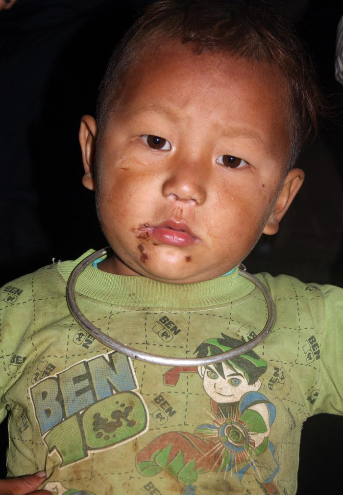 Một số em thì miệng lở loét, mặt mũi nhem nhuốc. Một số em thì miệng lở loét, mặt mũi nhem nhuốc.