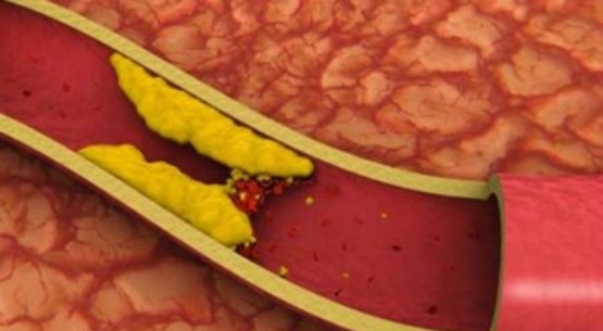 Enzyme bromelain trong quả dứa ngăn ngừa sự tích tụ của chất béo, phòng tránh xơ vữa động mạch. Enzyme bromelain trong quả dứa ngăn ngừa sự tích tụ của chất béo, phòng tránh xơ vữa động mạch.