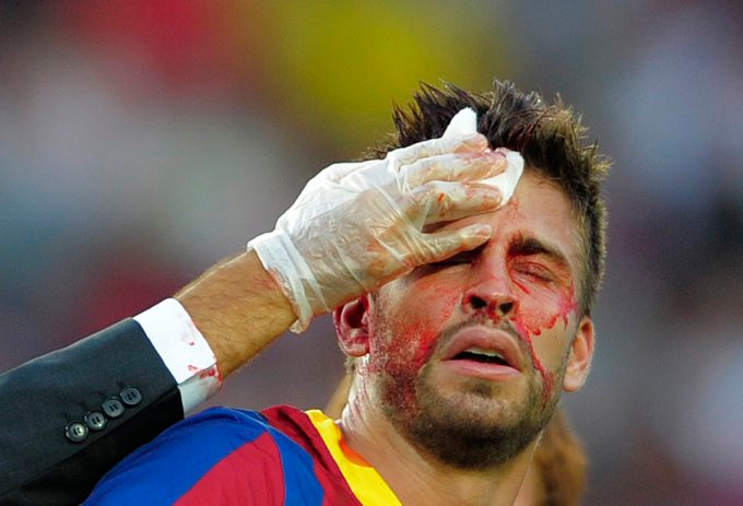 Gerard Pique đã có một pha va chạm rất mạnh với thủ môn Juan Calatayud bên phía Hercules. Pha va chạm này khiến cựu trung vệ của M.U rách mặt và đổ khá nhiều máu. Gerard Pique đã có một pha va chạm rất mạnh với thủ môn Juan Calatayud bên phía Hercules. Pha va chạm này khiến cựu trung vệ của M.U rách mặt và đổ khá nhiều máu.