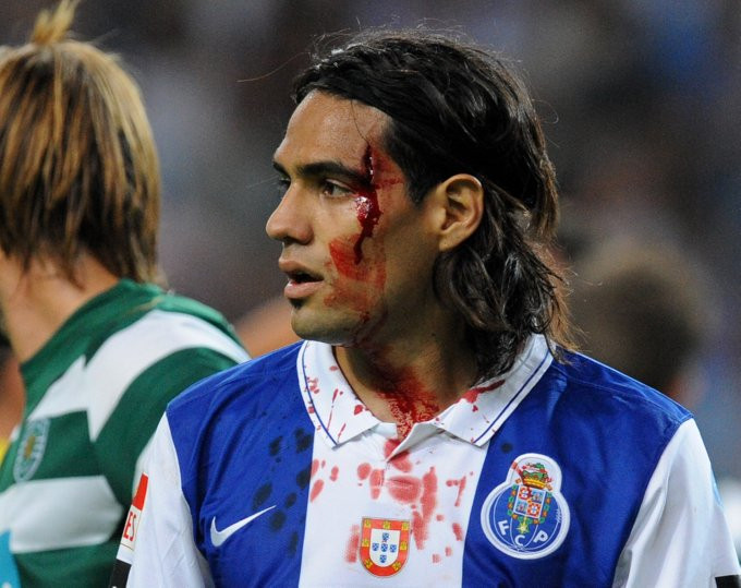 Siêu sao Radamel Falcao bị rách một vết rất dài ở trên mặt. Siêu sao Radamel Falcao bị rách một vết rất dài ở trên mặt.