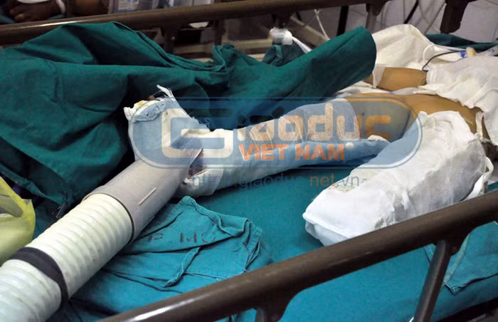 Cuộc sống sau này của cháu cũng sẽ rất khó khăn khi một chân của cháu đã bị mất, còn chân kia thì bị gãy đùi...
