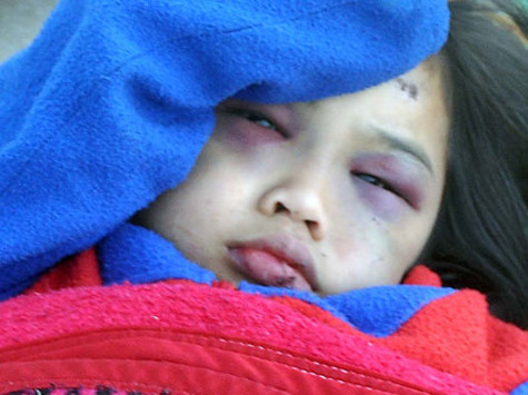 Bé Phi đang được điều trị tại bệnh viện Bé Phi đang được điều trị tại bệnh viện