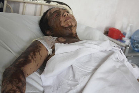 Chị Xuân cũng bị mù một mắt.