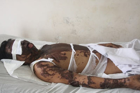 Anh Tuấn bị mù hai mắt và vết bỏng chi chít khắp người.