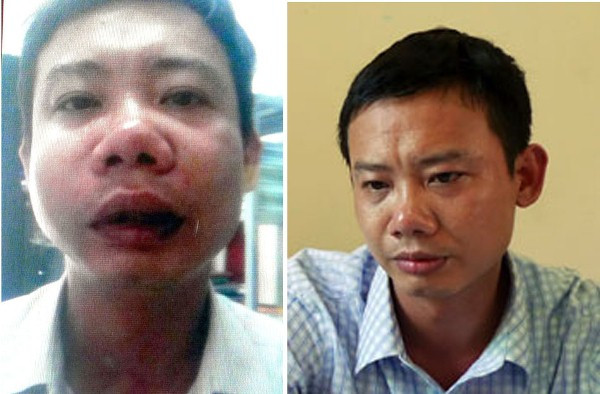 Hình ảnh chụp nhà báo Hán Phi Long sau khi bị đánh Hình ảnh chụp nhà báo Hán Phi Long sau khi bị đánh