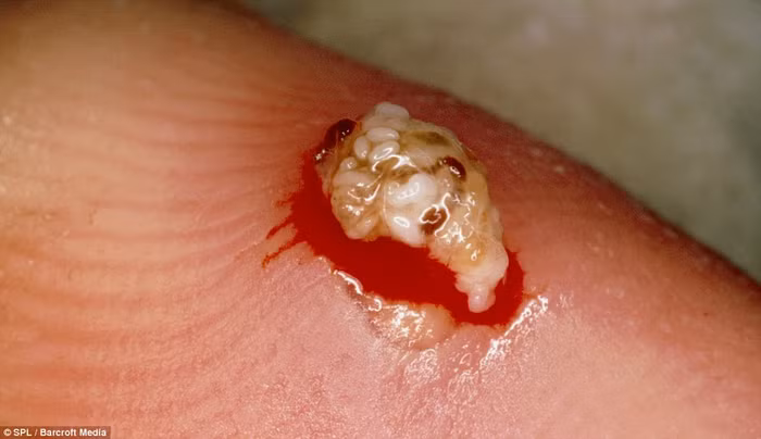 Đây là con rệp kẽ ngón tay và trứng của nó. Loài rệp này chuyên luồn dưới da để hút máu