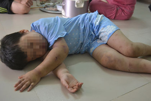 Bé 10 tuổi bị cha đẻ hành hạ: Mẹ đi tù, bố dùng búa đinh 'dạy' con ảnh 1 Mẹ đi tù, bố dùng búa đinh "dạy" con, Tin tức trong ngày, bao hanh tre em, danh con, danh dap tre em, nguoc dai tre em, tai nan, chan thuong so nao, chan dong tam than, toi pham, bao, tin nhanh, tin hot, tin tuc