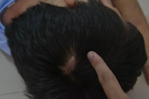 Một vết sẹo lớn trên đầu Một vết sẹo lớn trên đầu