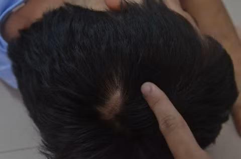 Một vết sẹo lớn trên đầu