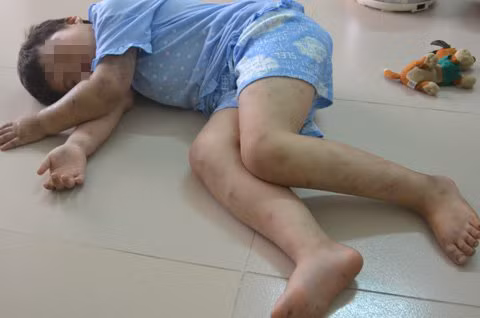 Bé Đặng Diễm Quỳnh với những vết sẹo chi chít trên cơ thể