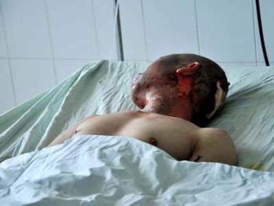 Anh Thắng được đưa vào bệnh viện trong tình trạng bỏng nặng. Hiện tại các bác sĩ đang theo dõi tình trạng của anh Thắng vì lo ngại tổn thương trong mạch máu. Anh Thắng được đưa vào bệnh viện trong tình trạng bỏng nặng. Hiện tại các bác sĩ đang theo dõi tình trạng của anh Thắng vì lo ngại tổn thương trong mạch máu.