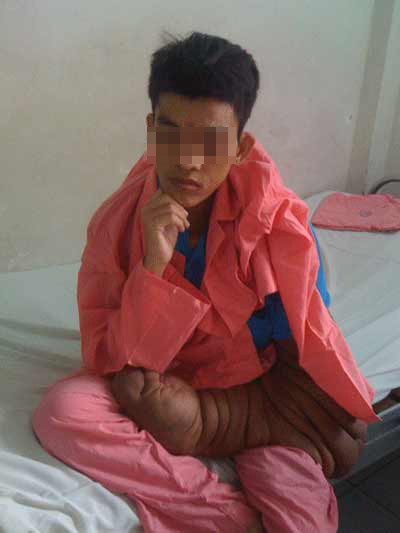 Cánh tay quái dị này khiến cuộc sống Vũ gặp nhiều khó khăn Cánh tay quái dị này khiến cuộc sống Vũ gặp nhiều khó khăn