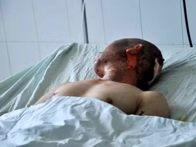 Anh Thắng được đưa vào bệnh viện trong tình trạng bỏng nặng. Hiện tại các bác sĩ đang theo dõi tình trạng của anh Thắng vì lo ngại tổn thương trong mạch máu. Anh Thắng được đưa vào bệnh viện trong tình trạng bỏng nặng. Hiện tại các bác sĩ đang theo dõi tình trạng của anh Thắng vì lo ngại tổn thương trong mạch máu.