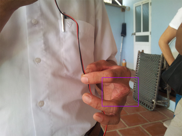 Lợi nhuận là vậy nhưng cái giá mà người dân Vĩnh Sơn phải trả cũng rất đắt. “Người dân ở đây hầu như người nào cũng cụt một ngón tay, ngón chân hoặc sẹo đầy người chi chít. Bản thân tôi đã bị mất một ngón tay vào năm 1987 do rắn cắn, ở Vĩnh Sơn đến nay đã có 10 người hy sinh vì rắn” – ông Quyết ngậm ngùi nói.