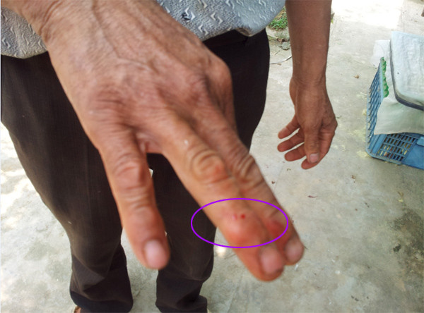 Những vết rắn cắn chảy máu như thế này không còn là nỗi sợ hãi của người dân Vĩnh Sơn. Mỗi người dân trở thành một chiến sỹ bắt rắn. Thậm chí tới đứa trẻ con 15 tuổi cũng phải biết tự bảo vệ mình trước rắn.