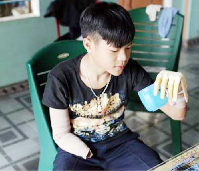 Hiếu đã có thể tự pha nước uống với cánh tay robot. Ảnh: AN Hiếu đã có thể tự pha nước uống với cánh tay robot. Ảnh: AN