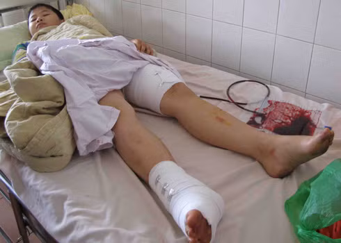 Em Hiếu bị thương, đang điều trị tại bệnh viện. Ảnh: Thanh Luận.