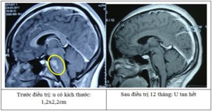 Kỹ thuật sử dụng dao gamma quay là kỹ thuật xạ phẫu tiên tiến trên thế giới, đưa Việt Nam trở thành một trong những nước đầu tiên trong trị u não Kỹ thuật sử dụng dao gamma quay là kỹ thuật xạ phẫu tiên tiến trên thế giới, đưa Việt Nam trở thành một trong những nước đầu tiên trong trị u não