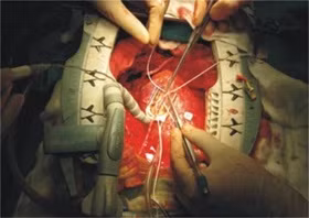 Phẫu thuật tim hở