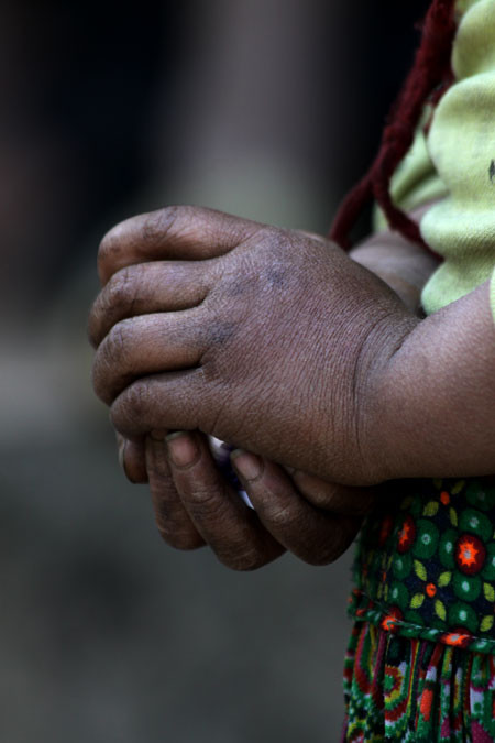 Lạnh giá, cóng buốt khiến những bàn tay bé nhỏ học sinh Pả Vi - Mèo Vạc - Hà Giang nứt nẻ, phù nề, (Ảnh Nam Phong) Lạnh giá, cóng buốt khiến những bàn tay bé nhỏ học sinh Pả Vi - Mèo Vạc - Hà Giang nứt nẻ, phù nề, (Ảnh Nam Phong)