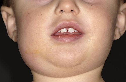 Cục Y tế dự phòng (Bộ Y tế) vừa đưa ra khuyến cáo phòng chống bệnh dịch quai bị - ảnh minh họa