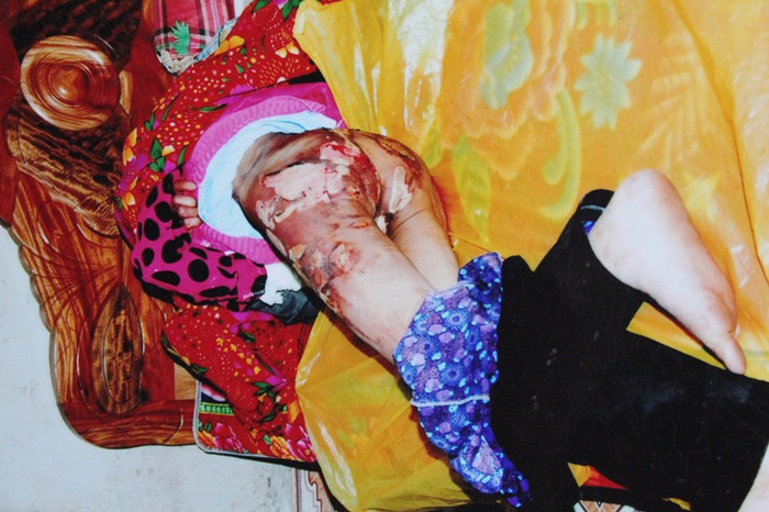 Bà "osin" Phạm Thị Phương đang nằm điều trị tại BV đa khoa Vân Đình trong tình trạng bỏng nặng ở nhiều nơi, đặc biệt ở vùng kín