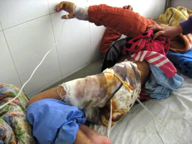 Bà "osin" Phạm Thị Phương đang nằm điều trị tại BV đa khoa Vân Đình trong tình trạng bỏng nặng ở nhiều nơi, đặc biệt ở vùng kín Bà "osin" Phạm Thị Phương đang nằm điều trị tại BV đa khoa Vân Đình trong tình trạng bỏng nặng ở nhiều nơi, đặc biệt ở vùng kín