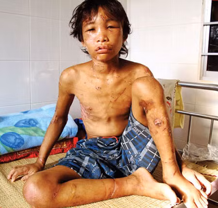 Trên người Hào Anh chi chít những vết thương do vợ chồng Giang - Thơm tra tấn. (Ảnh: Sài Gòn Giải Phóng)