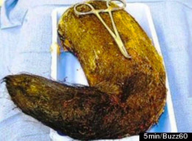 Khối hỗn hợp tóc và phấn mà cô gái đã nuốt.