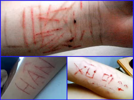 Tự rạch tay hành xác là một biểu hiện của lối sống và tâm lý không bình thường của một bộ phận giới trẻ hiện nay. Tự rạch tay hành xác là một biểu hiện của lối sống và tâm lý không bình thường của một bộ phận giới trẻ hiện nay.