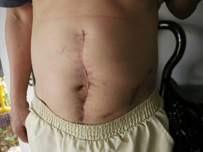 Vết thương ở bụng ông Trí