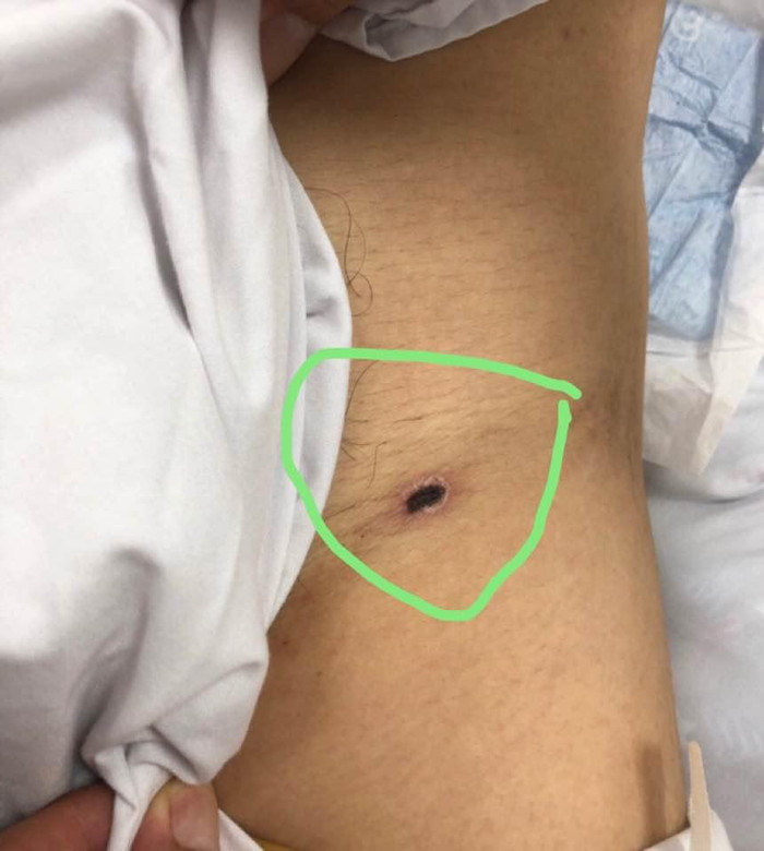 Ảnh vết mò cắn trên người bệnh nhân sốt mò.