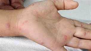 Theo số liệu từ Bộ Y tế, 2 tháng đầu năm nay, dịch bệnh chân tay miệng bùng phát mạnh, trung bình mỗi tuần phát hiện từ 900 - 1000 ca mắc bệnh. Ảnh minh họa Theo số liệu từ Bộ Y tế, 2 tháng đầu năm nay, dịch bệnh chân tay miệng bùng phát mạnh, trung bình mỗi tuần phát hiện từ 900 - 1000 ca mắc bệnh. Ảnh minh họa