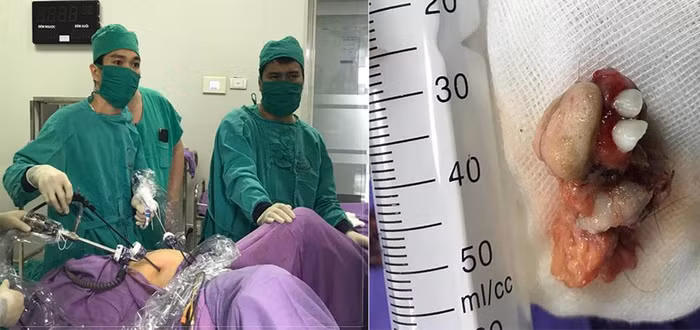 Ca mổ và khối u quái được đưa ra khỏi người bệnh nhân. (Ảnh: Bệnh viện sản nhi Quảng Ninh)