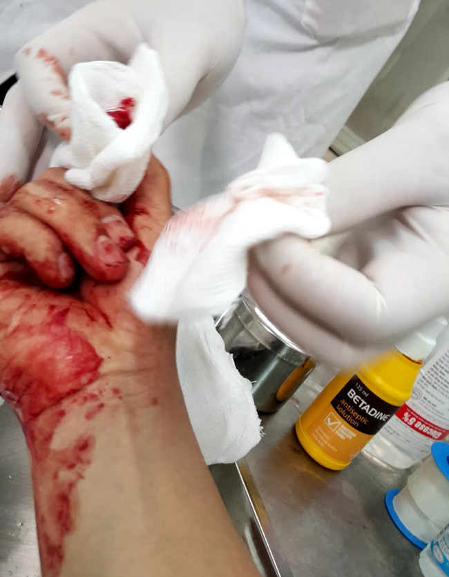 Nhà báo Đỗ Doãn Hoàng bị đánh dập ngón tay. Ảnh Lao động Nhà báo Đỗ Doãn Hoàng bị đánh dập ngón tay. Ảnh Lao động