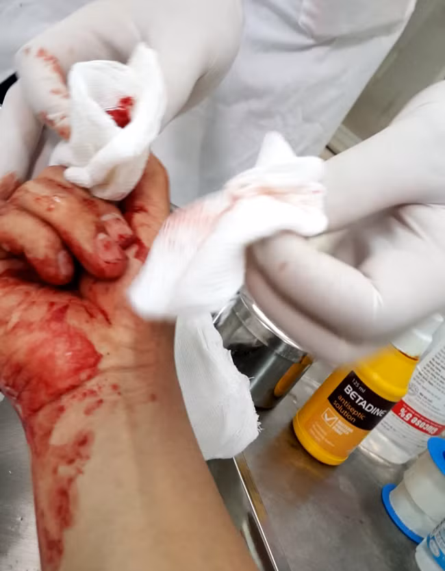 Nhà báo Đỗ Doãn Hoàng bị đánh dập ngón tay. Ảnh Lao động