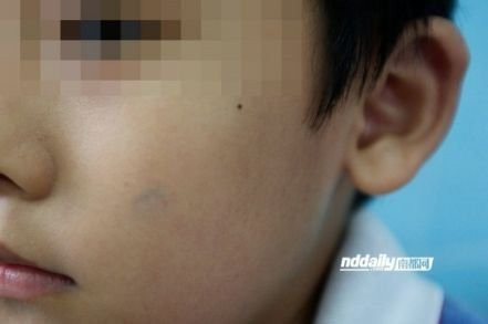 Một cậu bé lớp 3A bị phạt đóng dấu xanh lên má, dù đã dùng tay xóa đi vẫn không hết vết mực. Những học sinh này càng trở nên tự ti, mặc cảm trước bạn bè vì bị cười chê Một cậu bé lớp 3A bị phạt đóng dấu xanh lên má, dù đã dùng tay xóa đi vẫn không hết vết mực. Những học sinh này càng trở nên tự ti, mặc cảm trước bạn bè vì bị cười chê