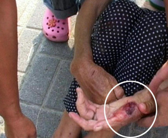 Bàn tay bật máu Bàn tay bật máu